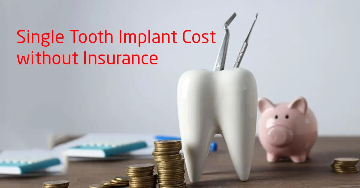 Single Tooth Implant Cost without Insurance